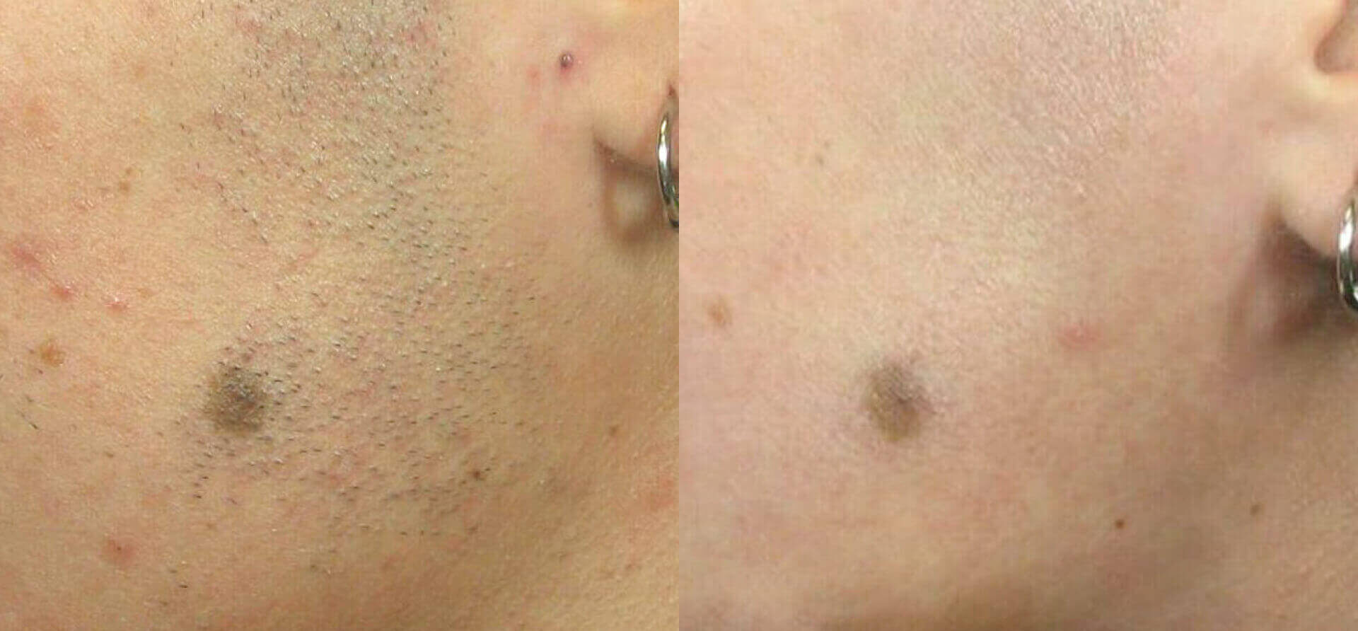 Cynosure-elite-plus-before-after-2 Skinspire Laser & Skin Clinic