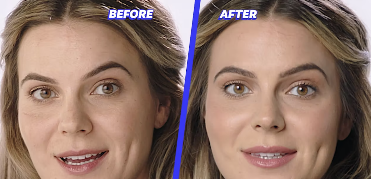 Skinspire Laser & Skin Clinic before and after1