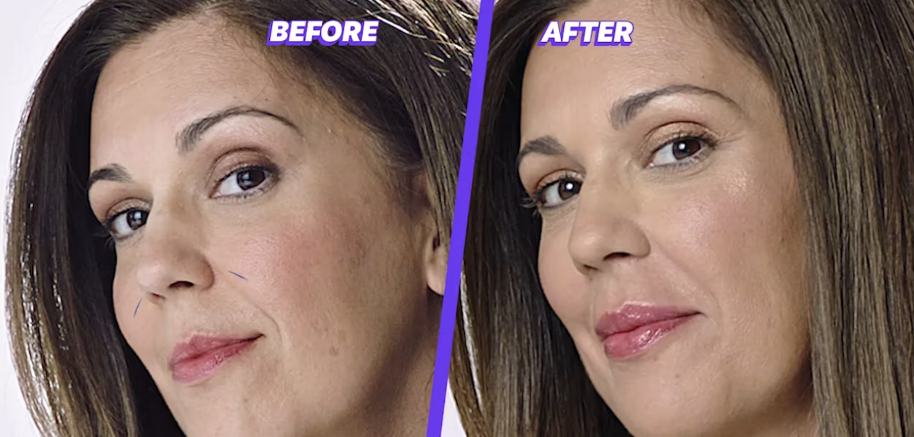 Skinspire Laser & Skin Clinic before and after5