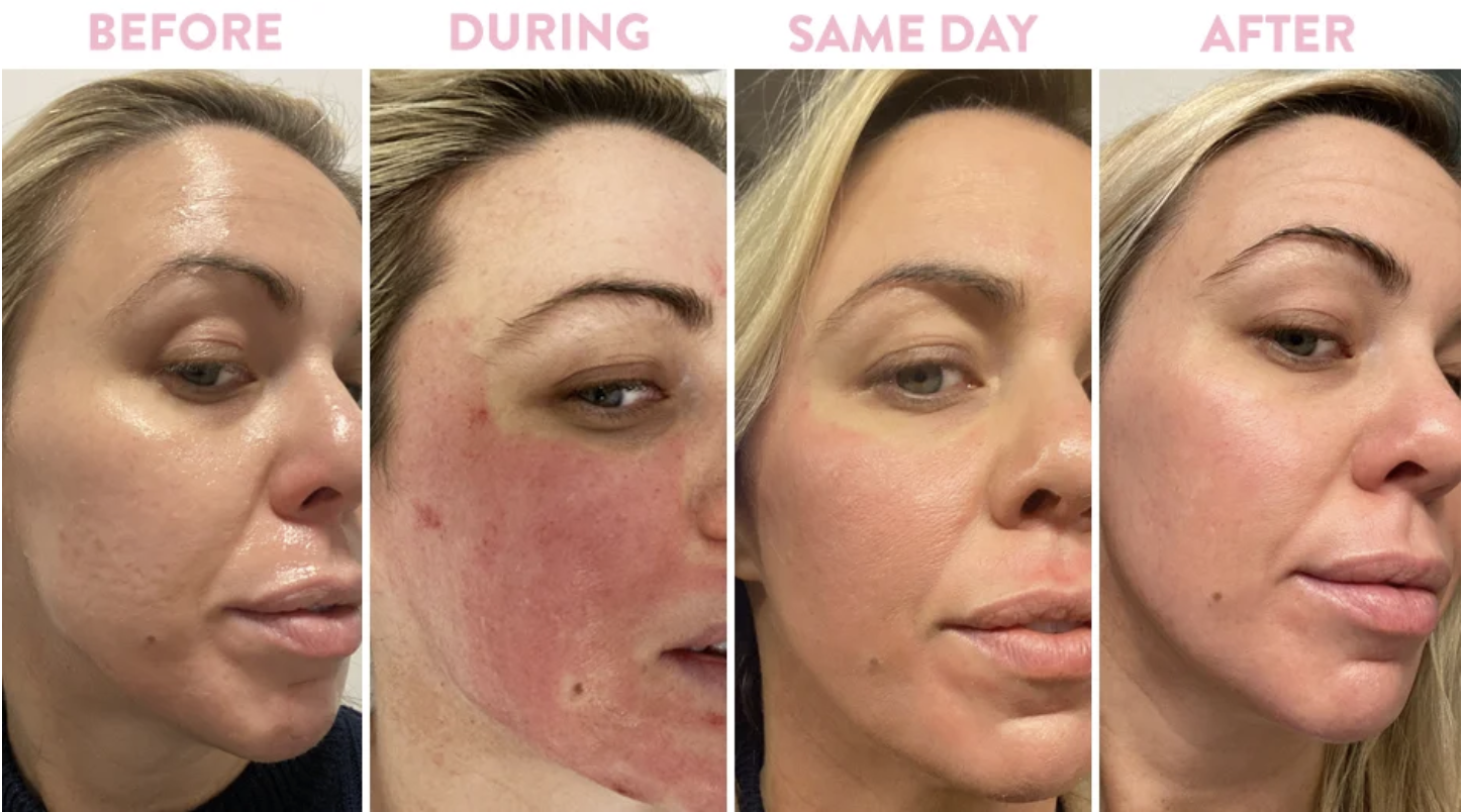 microneedling with PRP before after Skinspire Laser&Skin Clinic