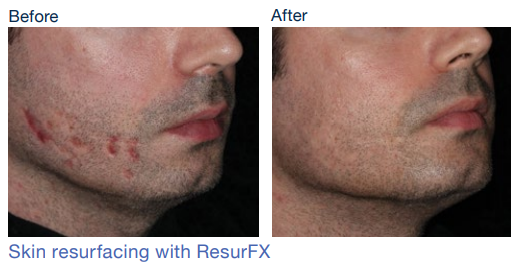 stellar m22 before&after4Skinspire Laser&Skin Clinic