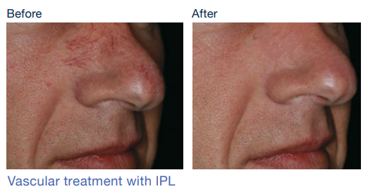 stellar m22 before&after5Skinspire Laser&Skin Clinic