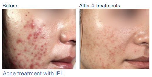 stellar m22 before&after6Skinspire Laser&Skin Clinic