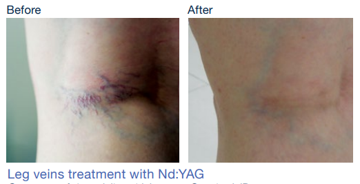 stellar m22 before&after7Skinspire Laser&Skin Clinic