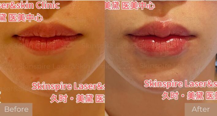 lip filler Skinspire Laser & Skin Clinic