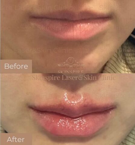 lip filler Skinspire Laser & Skin Clinic