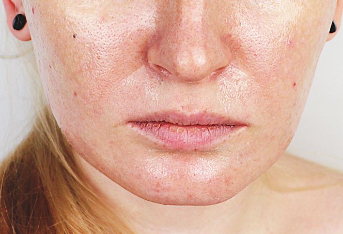 oily skin skinspire laser&skin clinic