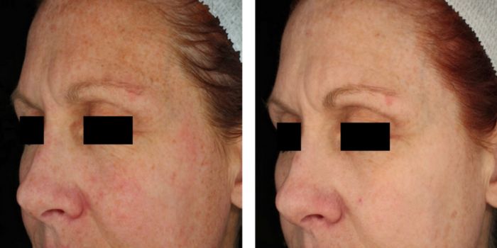 picosure before and after (2)
