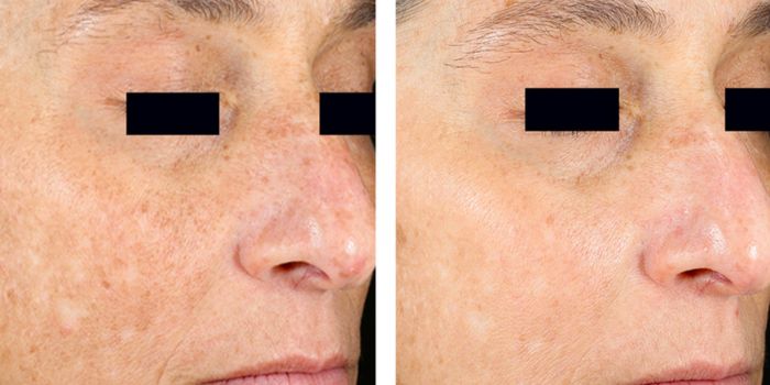 picosure before and after (3)