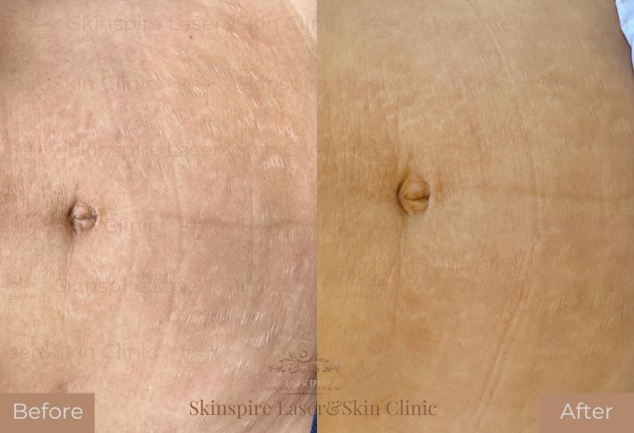 rf microneedling Skinspire Laser&Skin Clinic