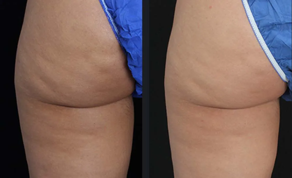 profound-cellulite-leyda-bowes-md-3m-1tx.jpg